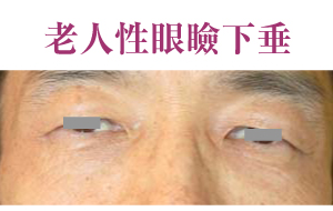 老人性眼瞼下垂 老人性眼瞼下垂