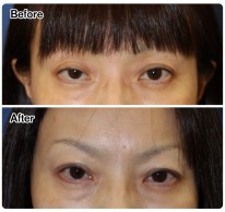眼瞼下垂症例-78 4acdacabdd6f48ab8cae2715b5e5226a