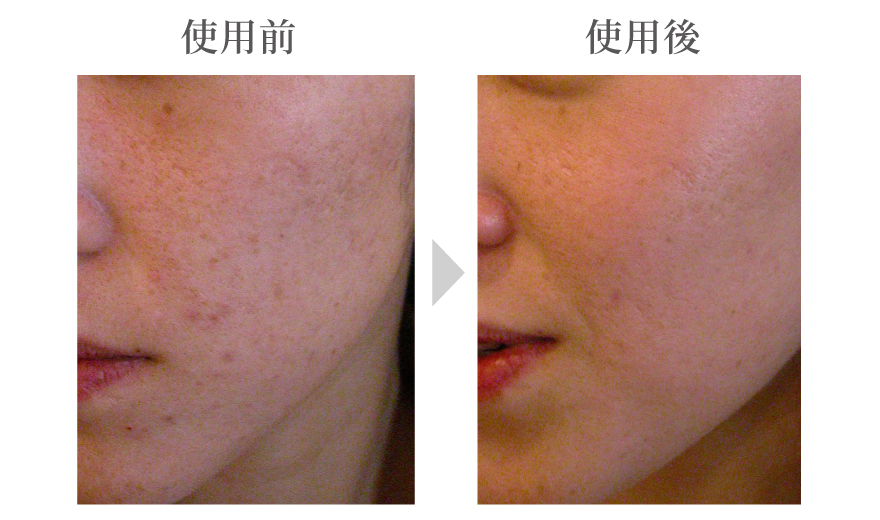メラフェード_BeforeAfter 4effe48c8abfa4eba0e2b86378e08560