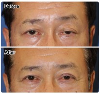 眼瞼下垂症例-81 6549ad2de113d9b19281d9d9258baab3