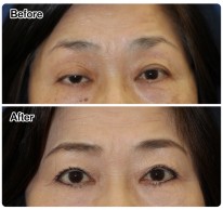 眼瞼下垂症例-96 72823a4b081fe8a53cb60f3c69d9e1ed