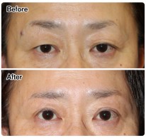 眼瞼下垂症例-102 a3811d6e5eb635c52d924593133fccc2