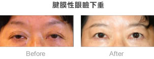 腱膜性眼瞼下垂_症例