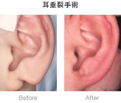 耳垂裂手術-症例