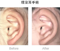 埋没耳手術-症例