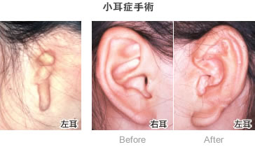 小耳症手術-症例