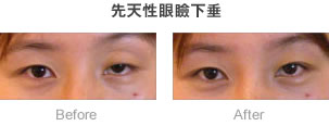 先天性眼瞼下垂-症例