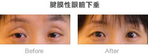 腱膜性眼瞼下垂_症例