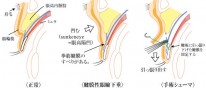 眼瞼挙筋短縮術