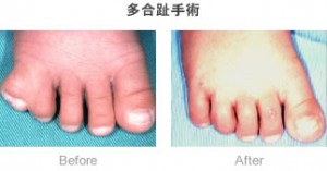 多合趾手術-症例